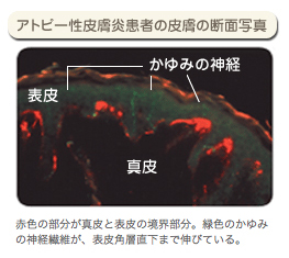 アトピー性皮膚炎患者の皮膚の断面写真