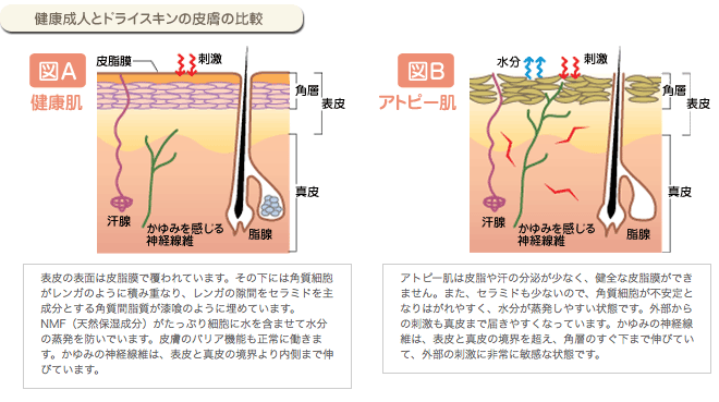 健康成人とドライスキンの皮膚の比較